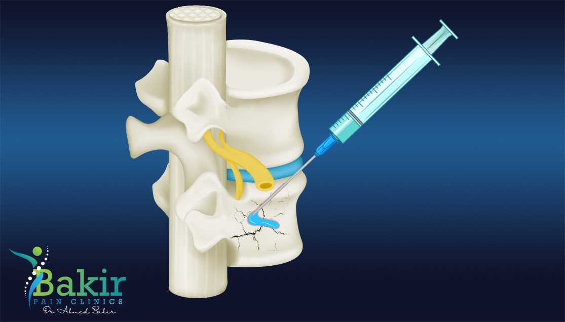  الحقن الأسمنتي -علاج الألم التداخلي - علاج الألم - افضل دكتور علاج الالم في مصر -أخصائي علاج الألم